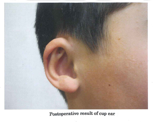Postoperative result of cup ear