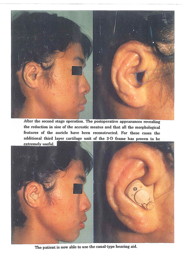 Auricular reconstruction following ENT surgery