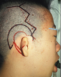 Intra-operative appearance (15% Low hairline)