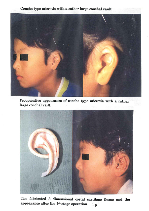 Concha type microtia with a large conchal vault