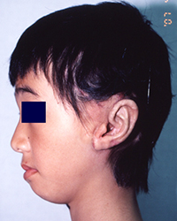 Intra-operative appearance (50% Low hairline)