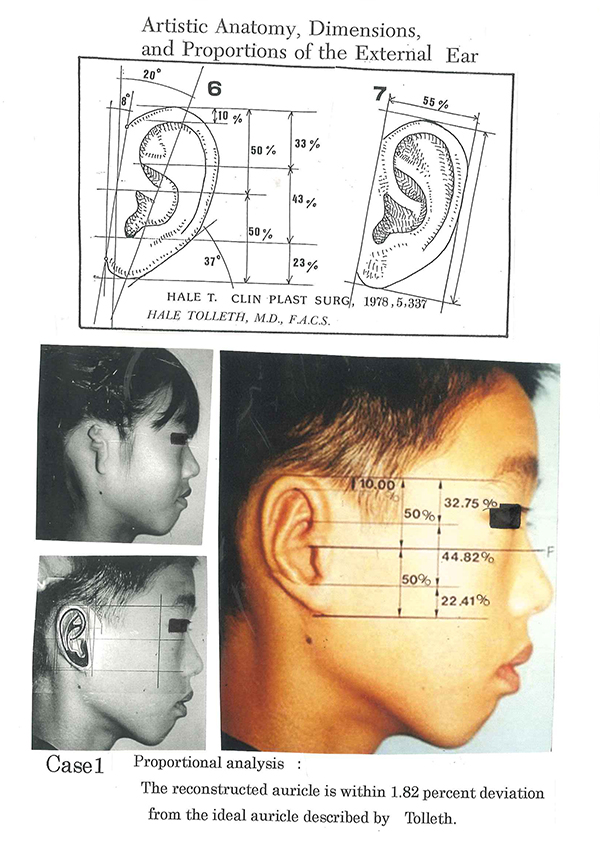 Accuracy evaluation on proportions of the reconstructed auricle / microtia surgery.