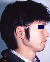 Post-operative appearance with Nagata method