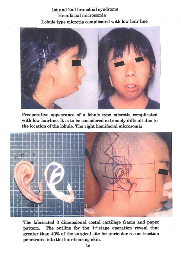 1st and 2st branchial syndrome:Hemifacial microsomia Lobule type microtia complicated with low hair line