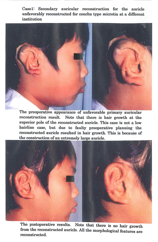 Secondary auricular reconstruction for the auricle unfavorably recibstructed for concha type microtia at a different institution