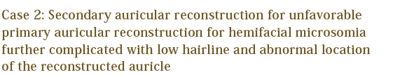 Case 2: Secondary auricular reconstruction for unfavorable primary auricular reconstruction for hemifacial microsomia further complicated with low hairline and abnormal location of the reconstructed auricle