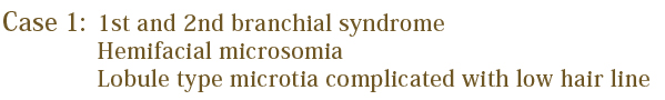 1st and 2st branchial syndrome:Hemifacial microsomia Lobule type microtia complicated with low hair line