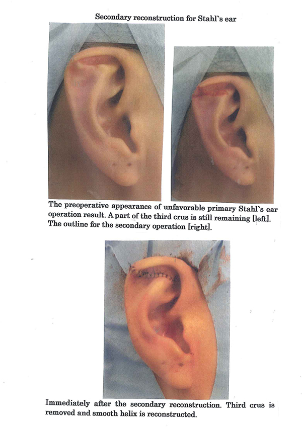 Secondary reconstruction for Stahl's ear