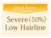 Severe (50%) Low Hairline