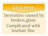 laceration caused by broken glass Complicated with lowhair line