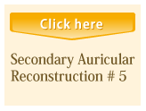 Secondary Auricular Reconstruction #3