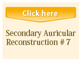 Secondary Auricular Reconstruction #7